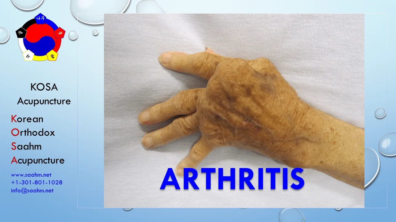 KOSA Acupuncture for Arthritis