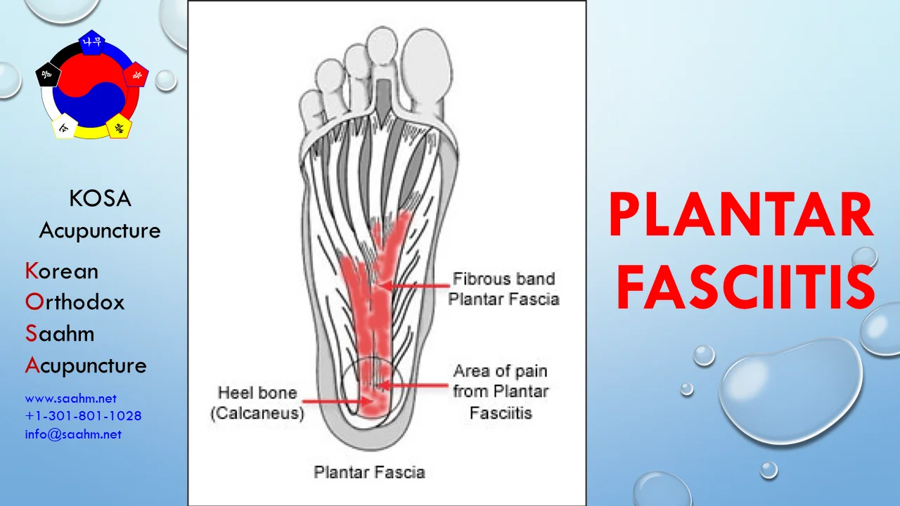 Plantar Fasciitis Treatment