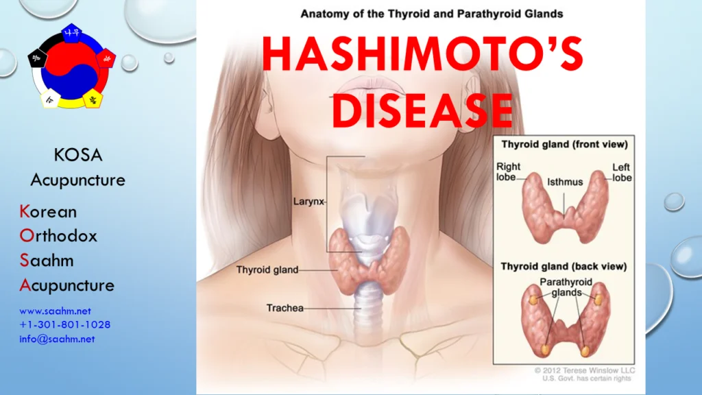 Hashimoto Disease