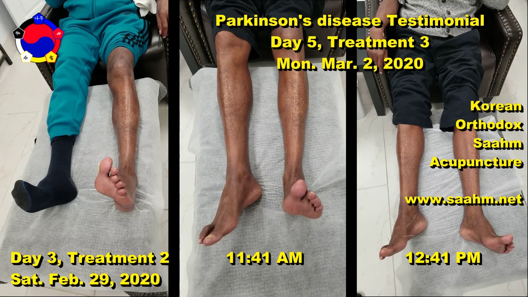 Parkinson Disease