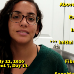 Anxiety, Acne, Fibroadenoma Testimonial Tx 7, Day 13 by KOSA Acupuncture