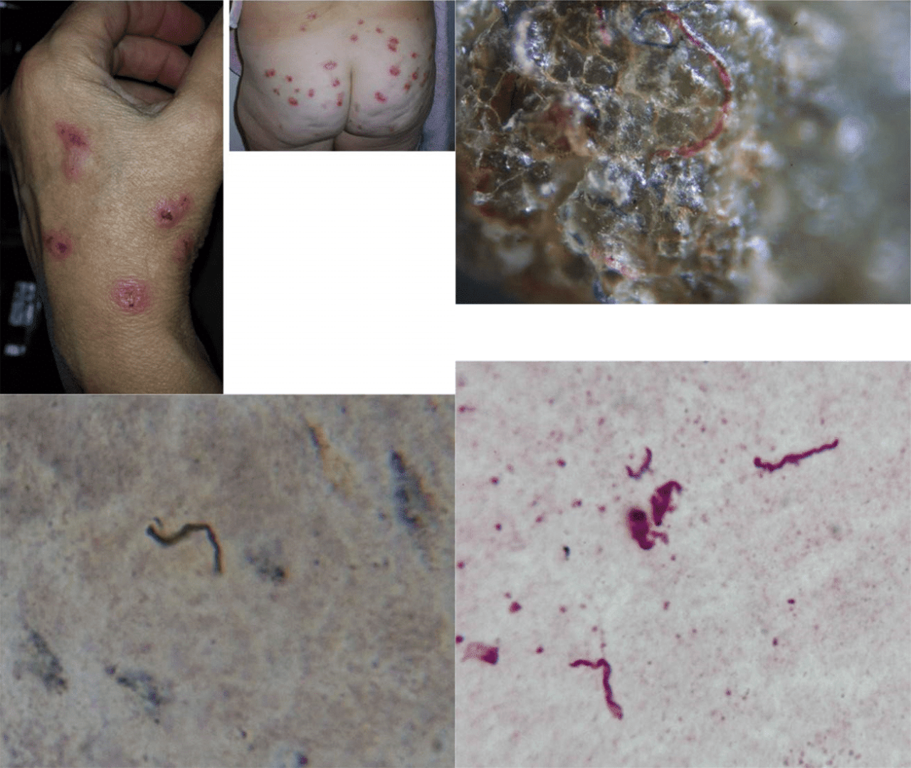 Morgellons