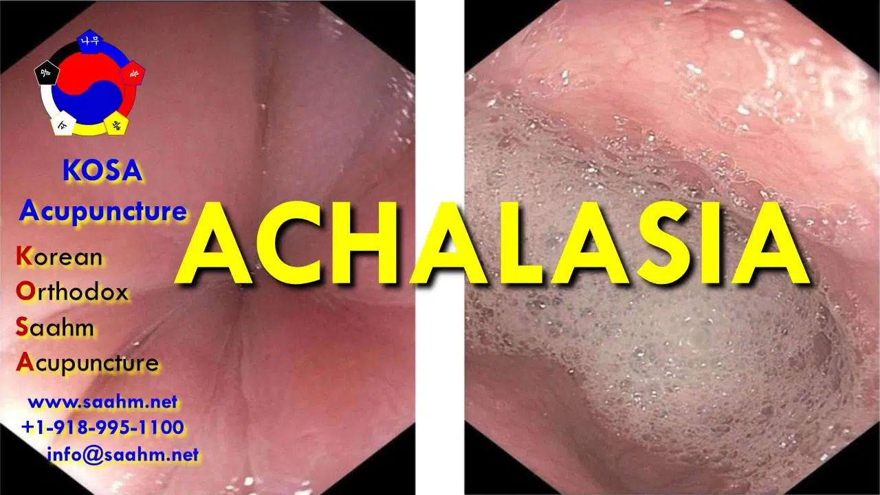 Achalasia testimonial - KOSA Acupuncture in Jenks Oklahoma serving Tulsa and the vicinity