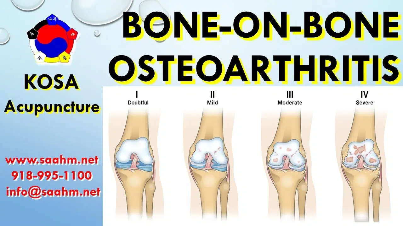 Testimonial - Treating Bone-On-Bone Osteoarthritis With KOSA Acupuncture