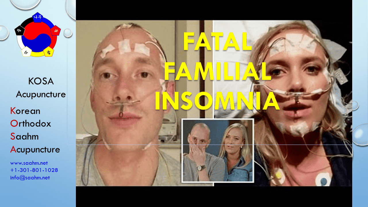 Health Info by KOSA Acupuncture 11 – Insomnia, Sleep, and Liver