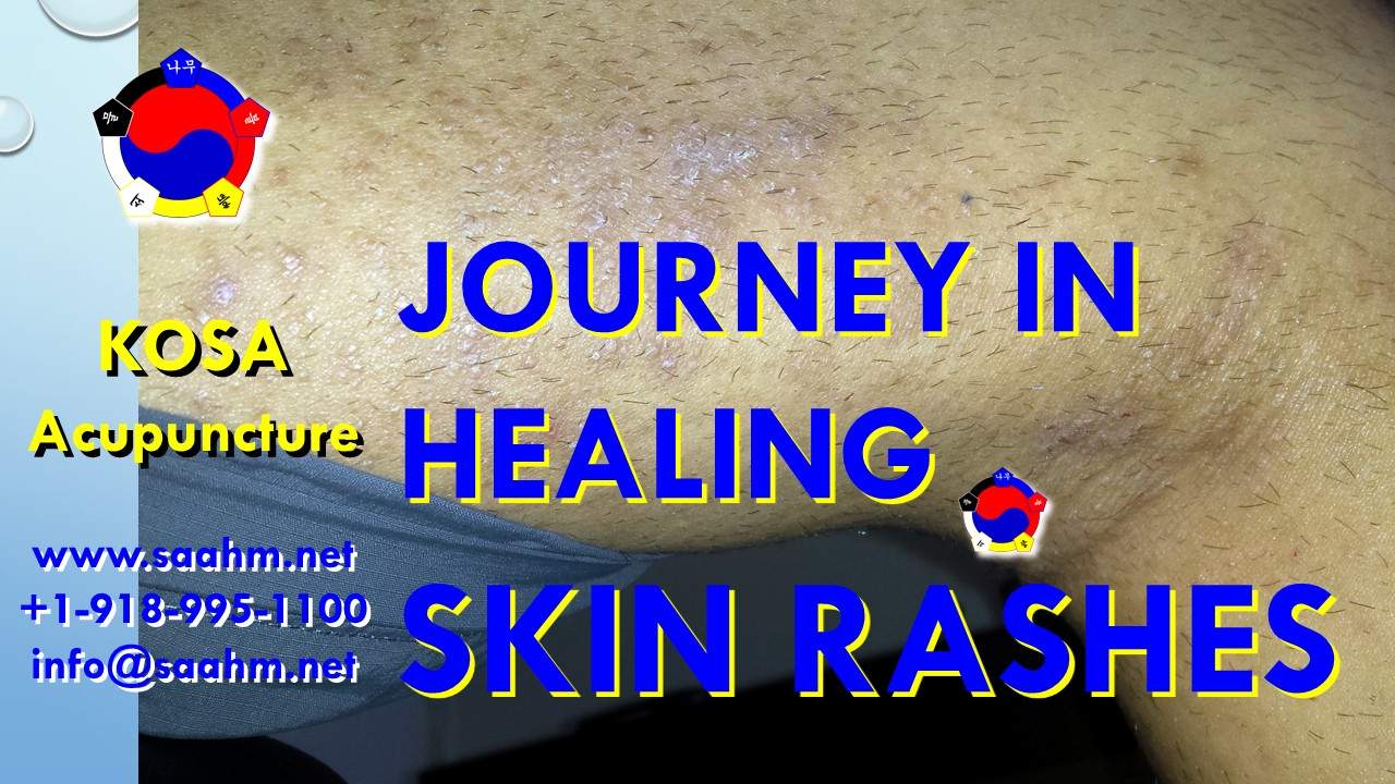 Skin Rashes and overlapping conditions have successfully been treated by KOSA Acupuncture with a very high success rate of 100%.When responsible organs get healthier they treat skin rashes and overlapping conditions naturally.