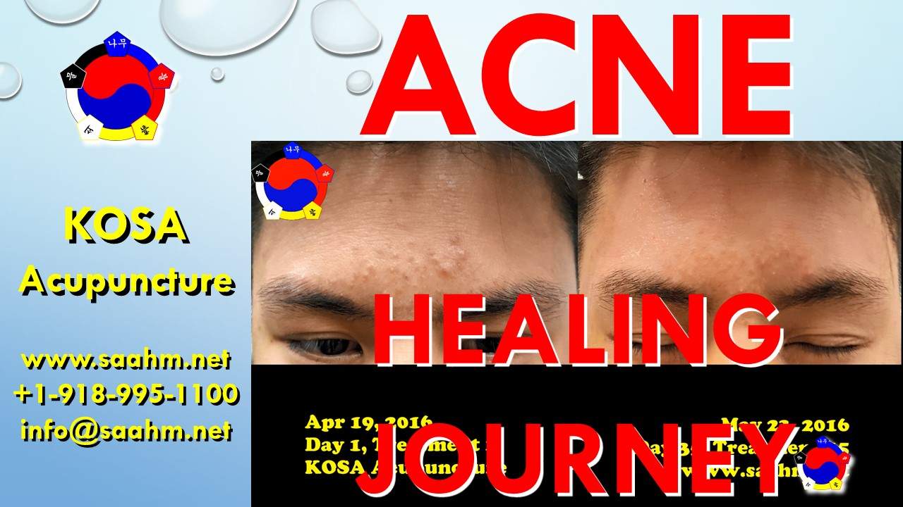 Acne Healing Journey With KOSA Acupuncture In Tulsa, OK